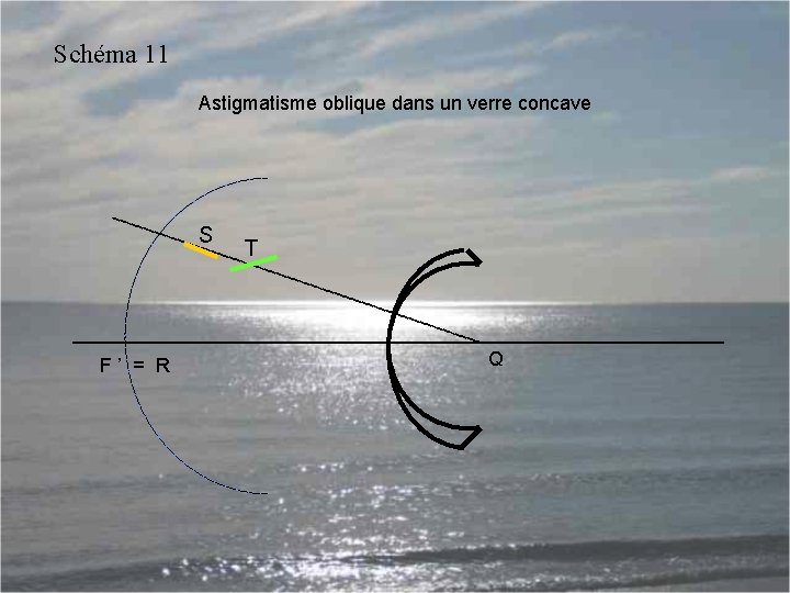 Schéma 11 Astigmatisme oblique dans un verre concave S F ’ = R T