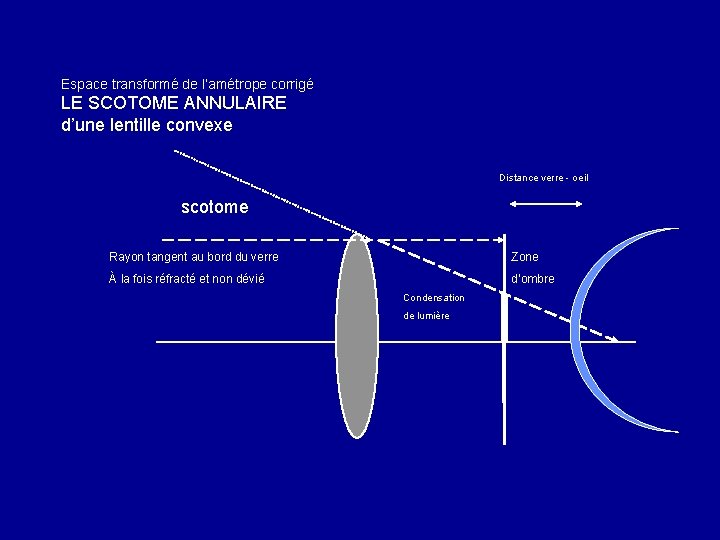 Espace transformé de l’amétrope corrigé LE SCOTOME ANNULAIRE d’une lentille convexe Distance verre -