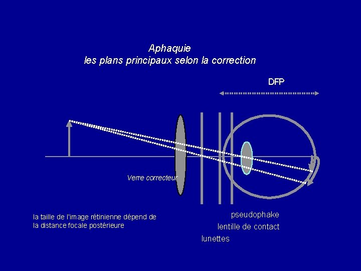 Aphaquie les plans principaux selon la correction DFP Verre correcteur la taille de l’image