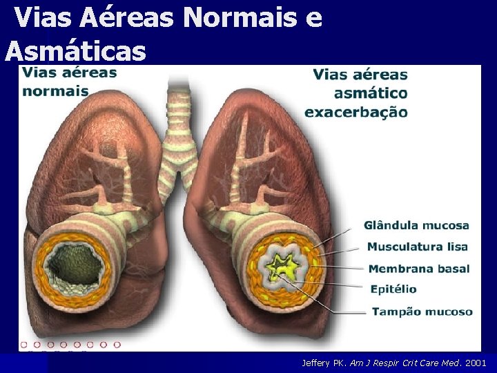 Vias Aéreas Normais e Asmáticas Jeffery PK. Am J Respir Crit Care Med. 2001