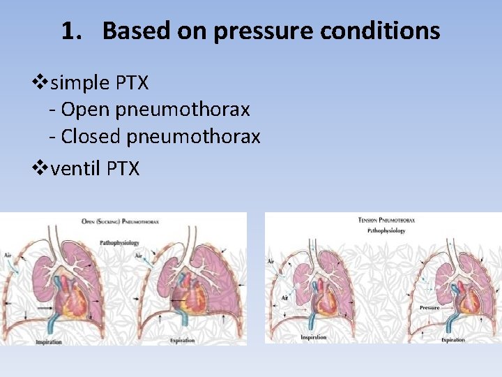 1. Based on pressure conditions vsimple PTX - Open pneumothorax - Closed pneumothorax vventil