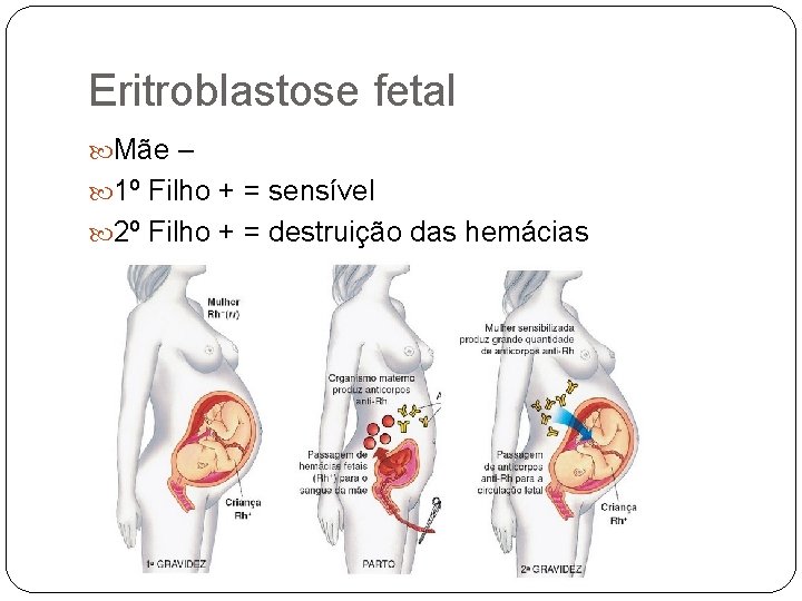 Eritroblastose fetal Mãe – 1º Filho + = sensível 2º Filho + = destruição
