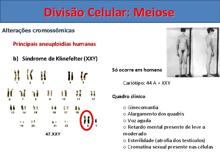 Divisão Celular: Meiose Alterações cromossômicas Principais aneuploidias humanas b) Síndrome de Klinefelter (XXY) Só