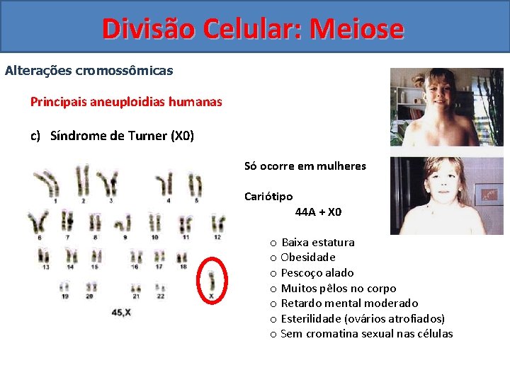 Divisão Celular: Meiose Alterações cromossômicas Principais aneuploidias humanas c) Síndrome de Turner (X 0)