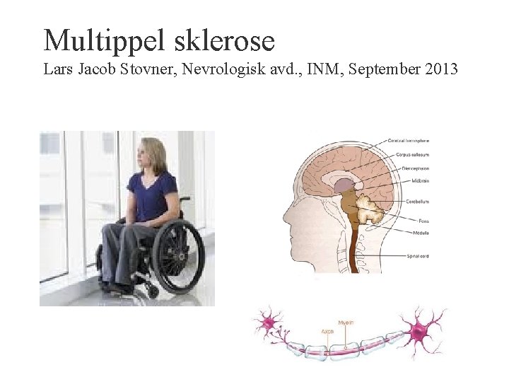 Multippel sklerose Lars Jacob Stovner, Nevrologisk avd. , INM, September 2013 