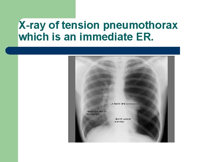 X-ray of tension pneumothorax which is an immediate ER. 