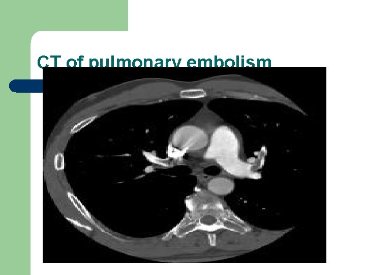 CT of pulmonary embolism 