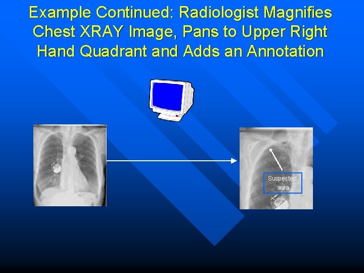 Example Continued: Radiologist Magnifies Chest XRAY Image, Pans to Upper Right Hand Quadrant and