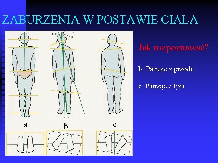 ZABURZENIA W POSTAWIE CIAŁA Jak rozpoznawać? b. Patrząc z przodu c. Patrząc z tyłu