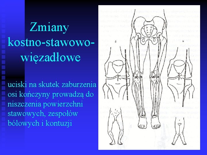 Zmiany kostno-stawowowięzadłowe uciski na skutek zaburzenia osi kończyny prowadzą do niszczenia powierzchni stawowych, zespołów
