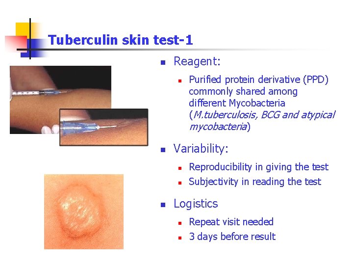 Tuberculin skin test-1 n Reagent: n n Variability: n n n Purified protein derivative