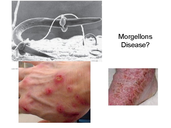 Morgellons Disease? 