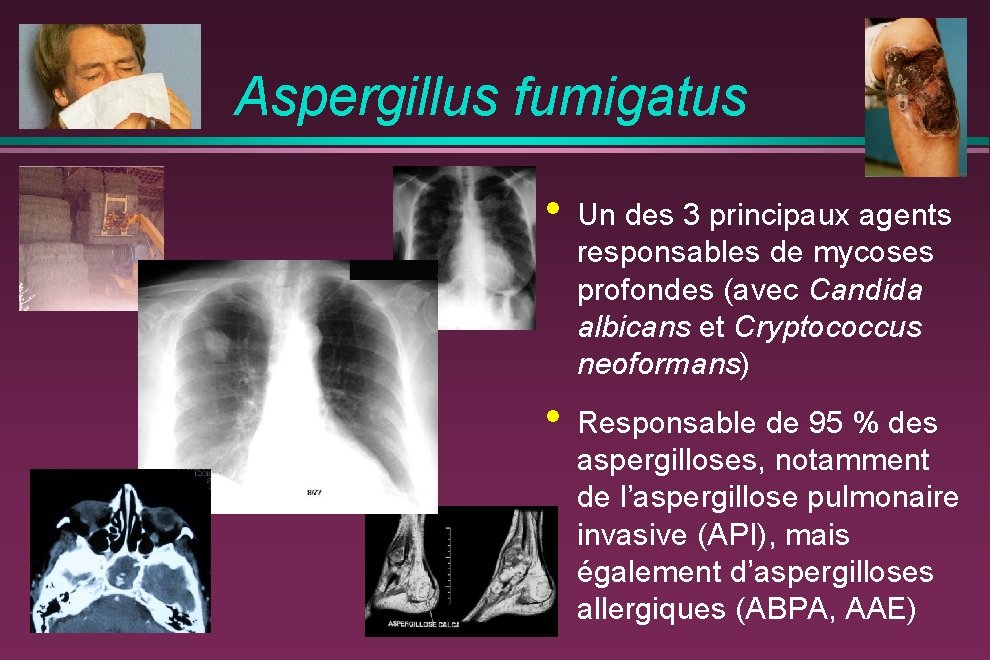 Aspergillus fumigatus • Un des 3 principaux agents responsables de mycoses profondes (avec Candida