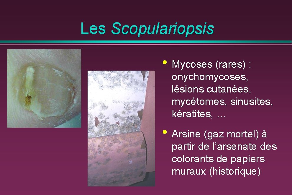  Les Scopulariopsis • Mycoses (rares) : onychomycoses, lésions cutanées, mycétomes, sinusites, kératites, …