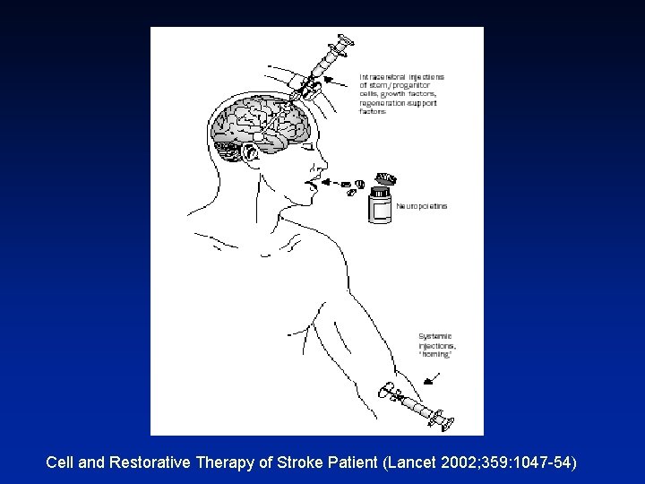 Cell and Restorative Therapy of Stroke Patient (Lancet 2002; 359: 1047 -54) 