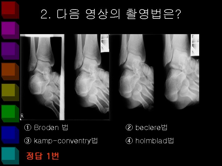 2. 다음 영상의 촬영법은? ① Broden 법 ② beclere법 ③ kamp-conventry법 ④ holmblad법 정답