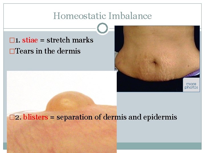 Homeostatic Imbalance � 1. stiae = stretch marks �Tears in the dermis � 2.