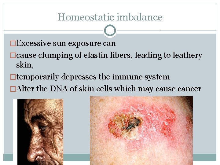 Homeostatic imbalance �Excessive sun exposure can �cause clumping of elastin fibers, leading to leathery