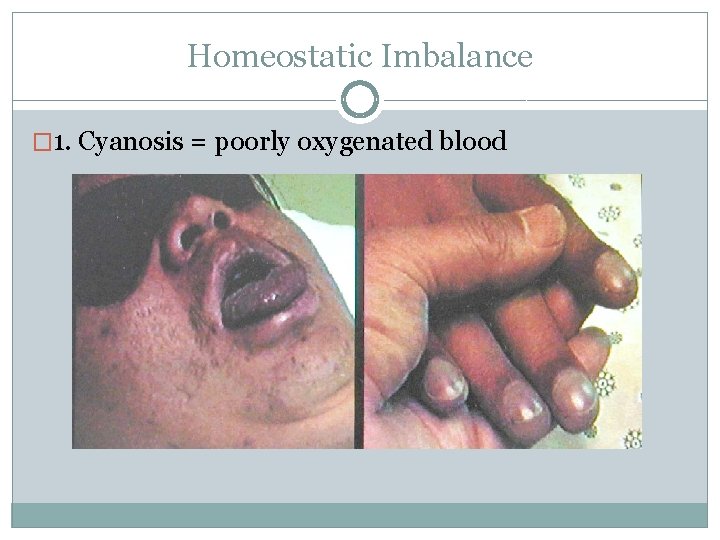 Homeostatic Imbalance � 1. Cyanosis = poorly oxygenated blood 