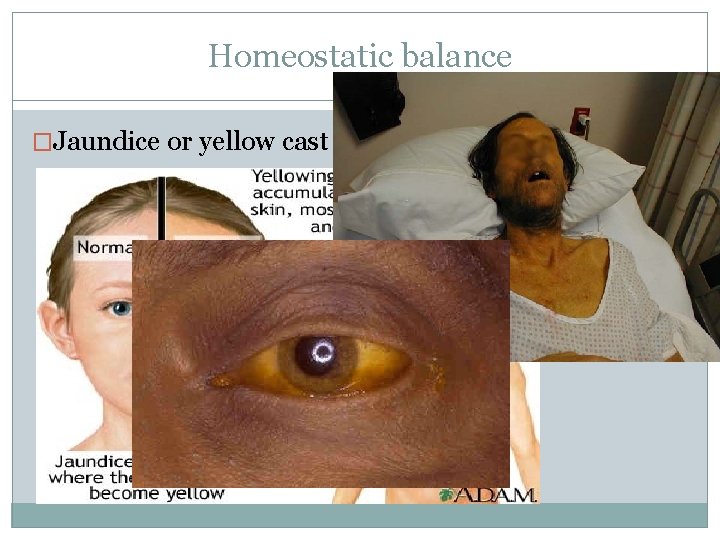 Homeostatic balance �Jaundice or yellow cast = 