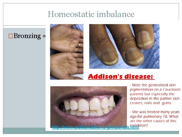 Homeostatic imbalance �Bronzing = http: //www. aldfoundation. org/materials. html 