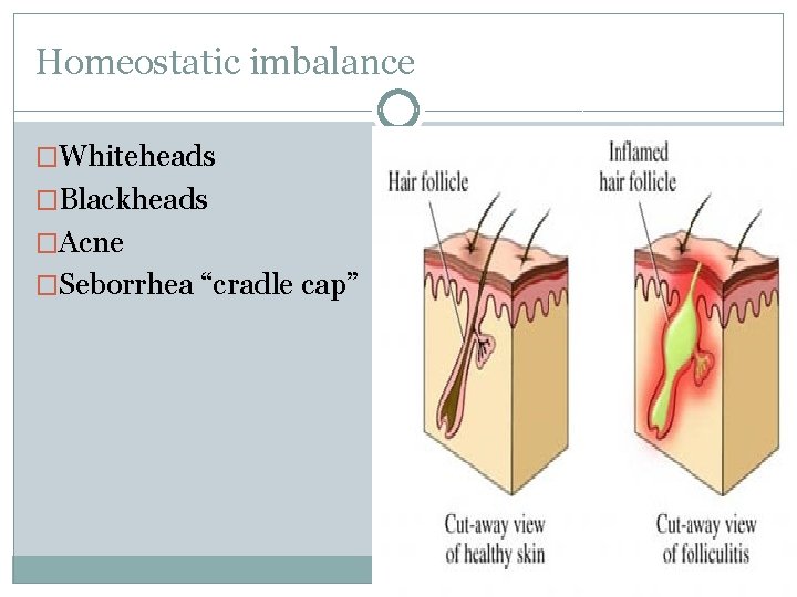 Homeostatic imbalance �Whiteheads �Blackheads �Acne �Seborrhea “cradle cap” 