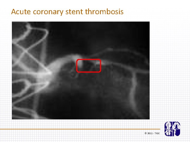 Acute coronary stent thrombosis © 2011 - TIGC 
