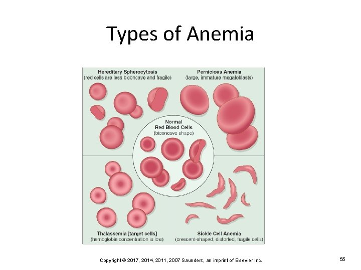 Types of Anemia Copyright © 2017, 2014, 2011, 2007 Saunders, an imprint of Elsevier