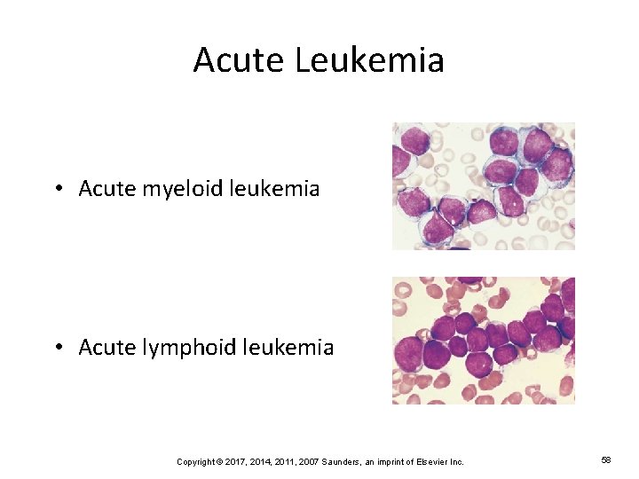 Acute Leukemia • Acute myeloid leukemia • Acute lymphoid leukemia Copyright © 2017, 2014,
