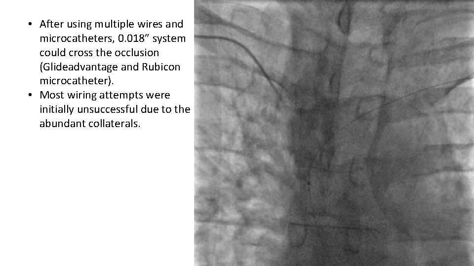  • After using multiple wires and microcatheters, 0. 018” system could cross the
