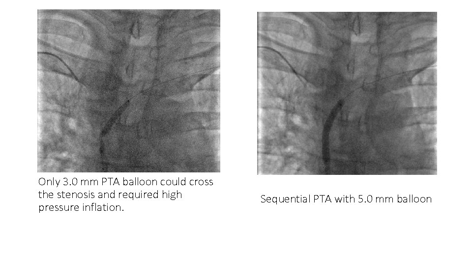 Only 3. 0 mm PTA balloon could cross the stenosis and required high pressure