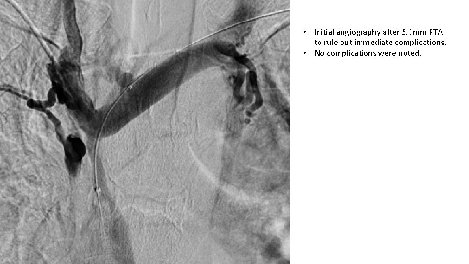  • Initial angiography after 5. 0 mm PTA to rule out immediate complications.