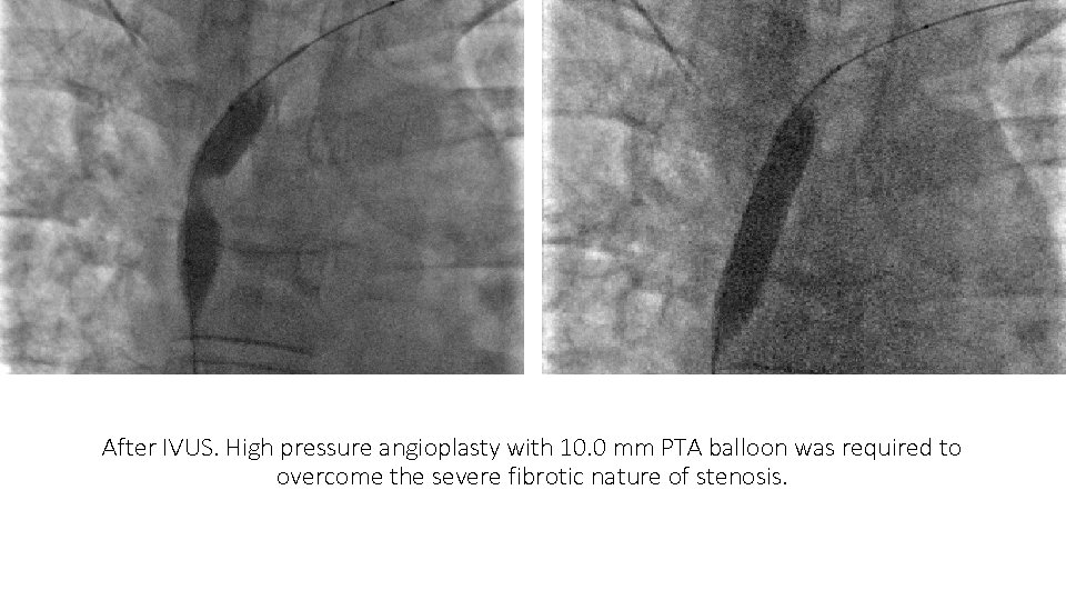 After IVUS. High pressure angioplasty with 10. 0 mm PTA balloon was required to