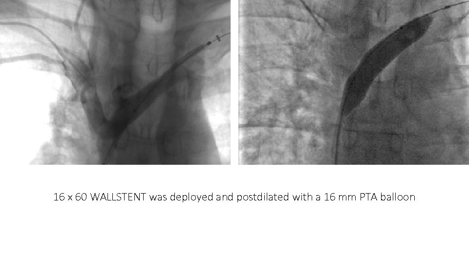 16 x 60 WALLSTENT was deployed and postdilated with a 16 mm PTA balloon