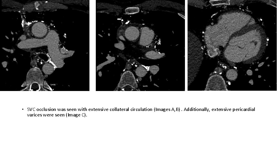  • SVC occlusion was seen with extensive collateral circulation (Images A, B). Additionally,