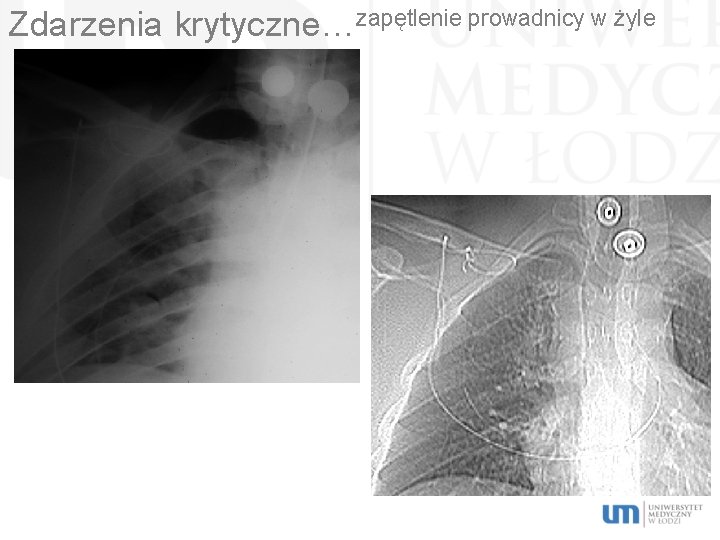 Zdarzenia krytyczne…zapętlenie prowadnicy w żyle 