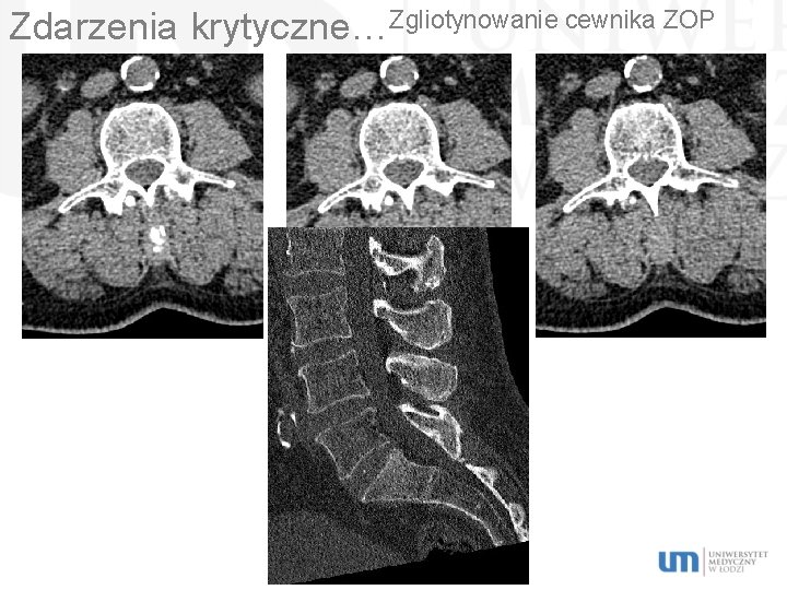 Zdarzenia krytyczne…Zgliotynowanie cewnika ZOP 