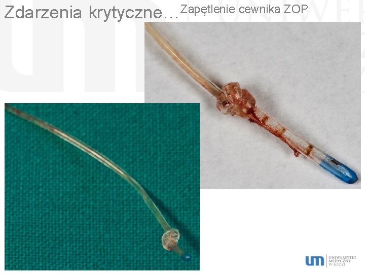 Zdarzenia krytyczne…Zapętlenie cewnika ZOP 