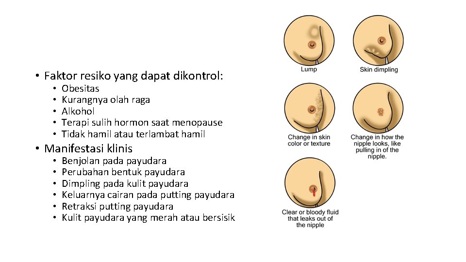  • Faktor resiko yang dapat dikontrol: • • • Obesitas Kurangnya olah raga