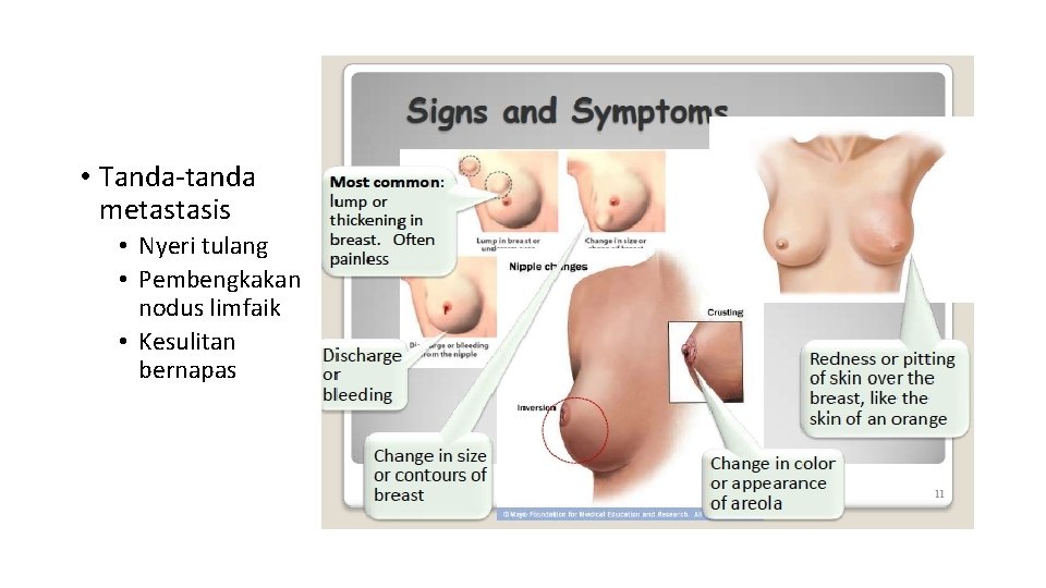  • Tanda-tanda metastasis • Nyeri tulang • Pembengkakan nodus limfaik • Kesulitan bernapas