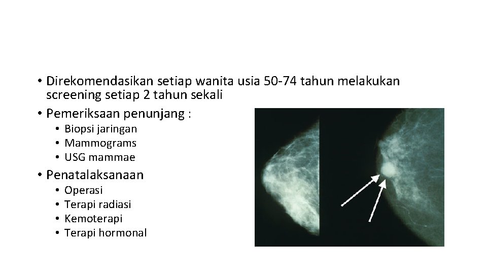  • Direkomendasikan setiap wanita usia 50 -74 tahun melakukan screening setiap 2 tahun