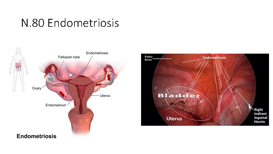 N. 80 Endometriosis 