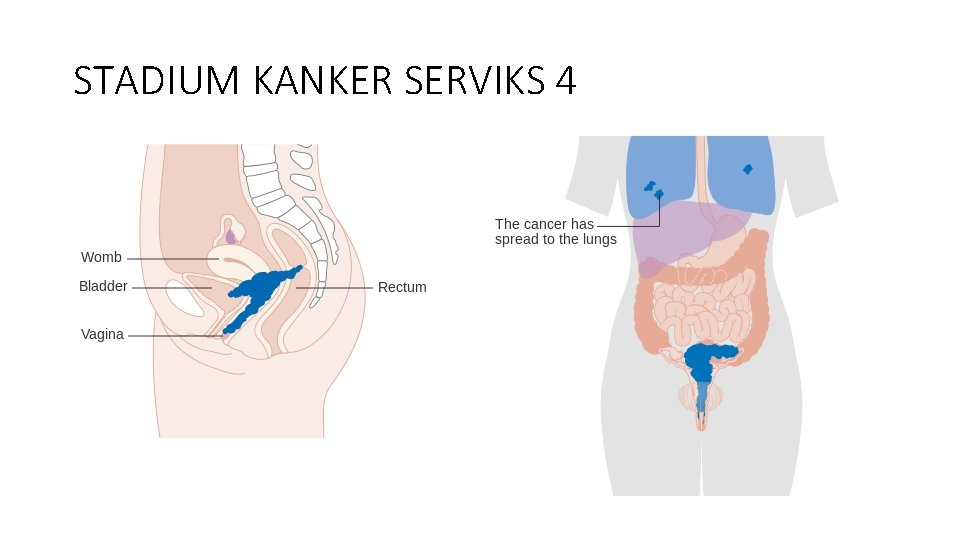 STADIUM KANKER SERVIKS 4 