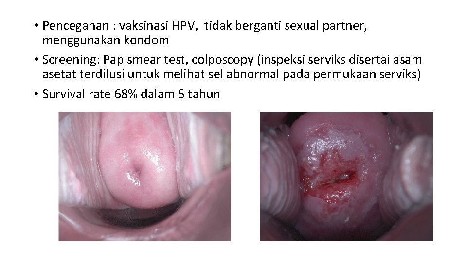  • Pencegahan : vaksinasi HPV, tidak berganti sexual partner, menggunakan kondom • Screening: