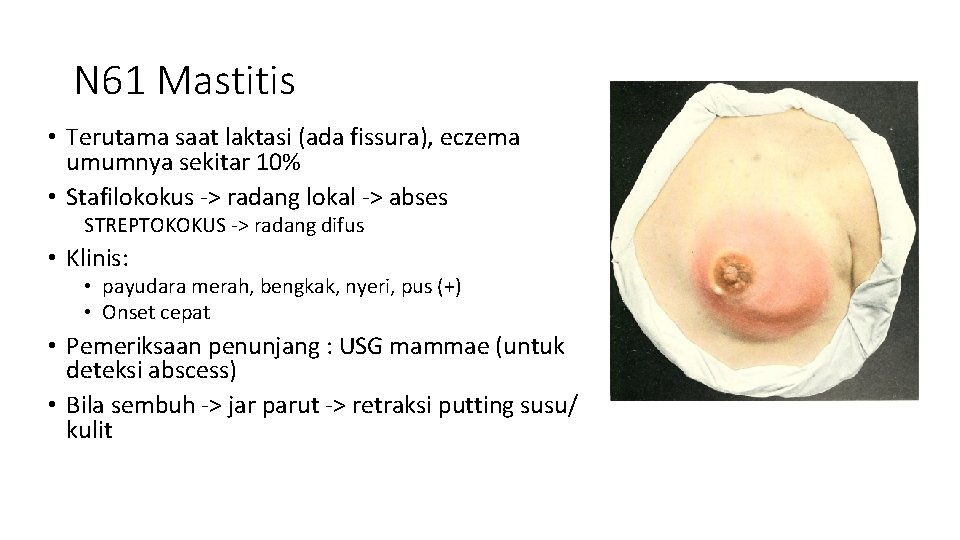 N 61 Mastitis • Terutama saat laktasi (ada fissura), eczema umumnya sekitar 10% • N 61 Mastitis • Terutama saat laktasi (ada fissura), eczema umumnya sekitar 10% •