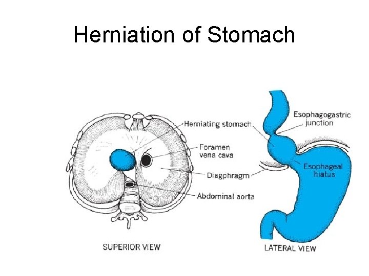 Herniation of Stomach Herniation of Stomach