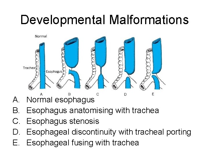 Developmental Malformations A. B. C. D. E. Normal esophagus Esophagus anatomising with trachea Esophagus