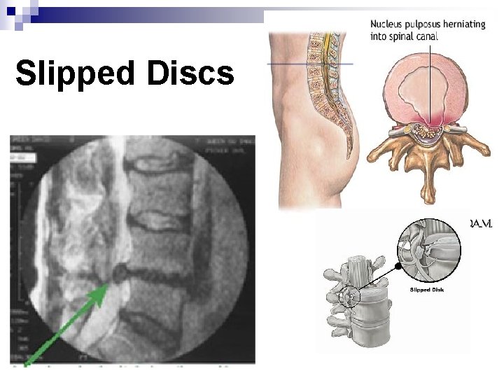 Slipped Discs 