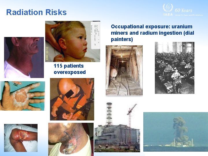 Radiation Risks Occupational exposure: uranium miners and radium ingestion (dial painters) 115 patients overexposed