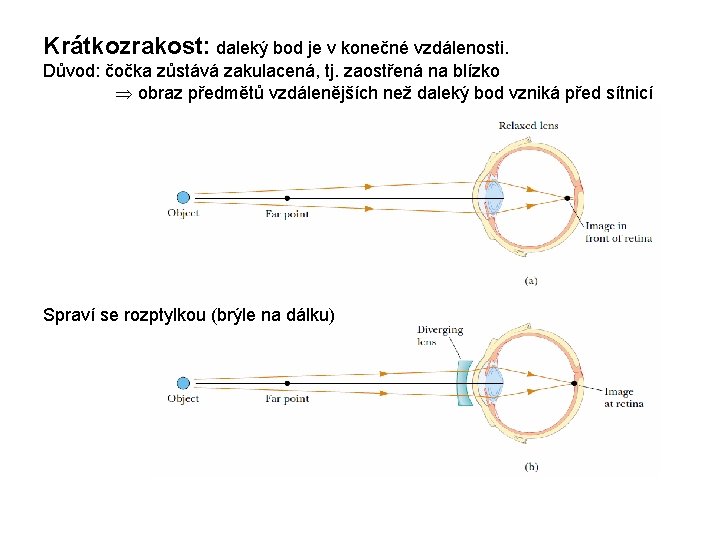 Krátkozrakost: daleký bod je v konečné vzdálenosti. Důvod: čočka zůstává zakulacená, tj. zaostřená na Krátkozrakost: daleký bod je v konečné vzdálenosti. Důvod: čočka zůstává zakulacená, tj. zaostřená na
